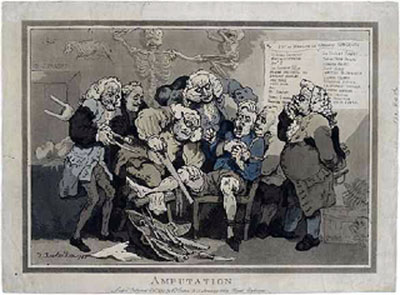 Rowlandson's amputation